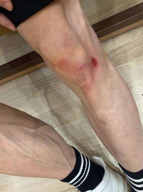 膝盖受伤的图片,康复之路与预防策略